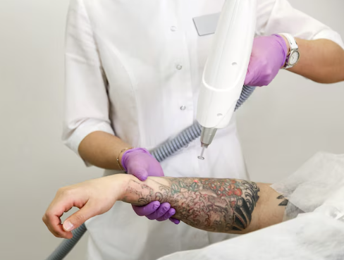 dimentica-tatuaggio-senza-cicatrici-laser-picoway immagine dell'articolo