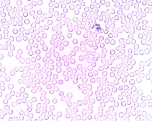 anemia-carenza-ferro-cause-sintomi-trattamenti immagine dell'articolo