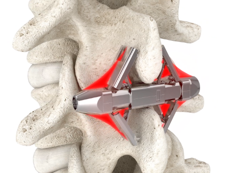 distanziatori-interspinosi-stenosi-vertebrale-soluzione immagine dell'articolo