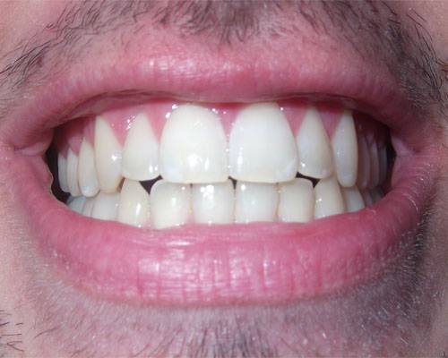 bruxismo-placca-neuromuscolare-bite-odontoiatria immagine dell'articolo
