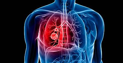 embolia-polmonare-sintomi-atipici-e-diagnosi-precoce immagine dell'articolo