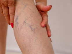 arteriopatia-periferica-prevenzione-diagnosi-e-trattamenti-innovativi immagine dell'articolo