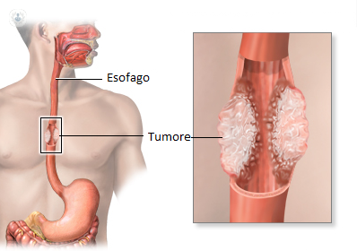tumore delll'esofago