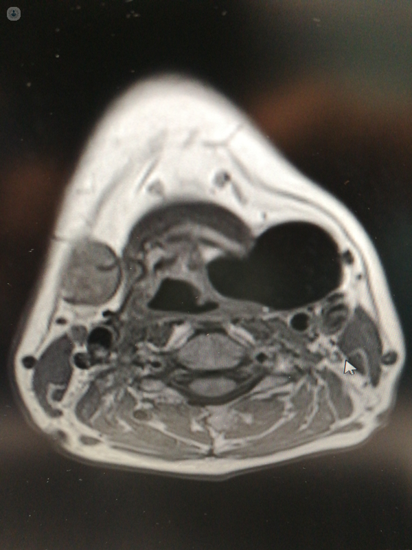 quadro radiologico laringocele