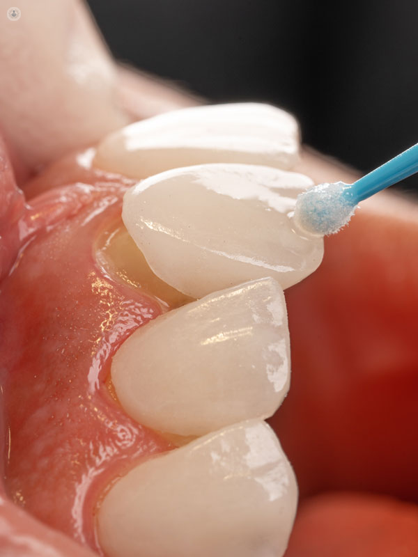 dentatura di un paziente in cui si collocano faccette dentali