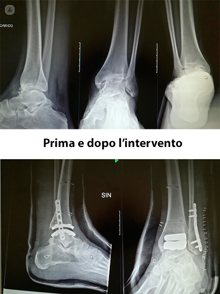 due radiografie di prima e dopo l'impianto di una protesi di caviglia