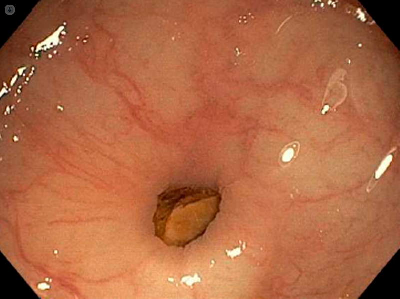 diverticoli