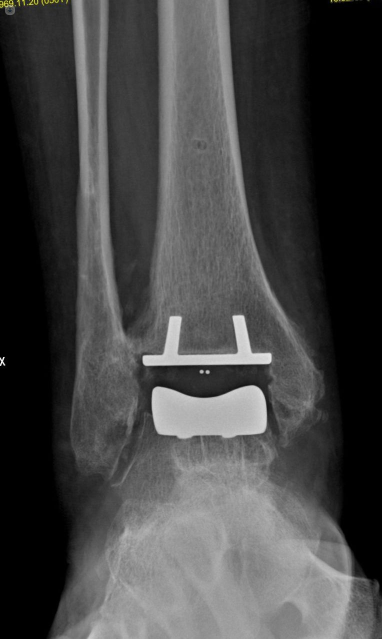 rx post-operatoria protesi caviglia