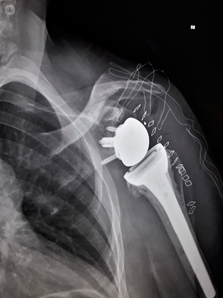 radiografia che mostra una protesi inversa di spalla