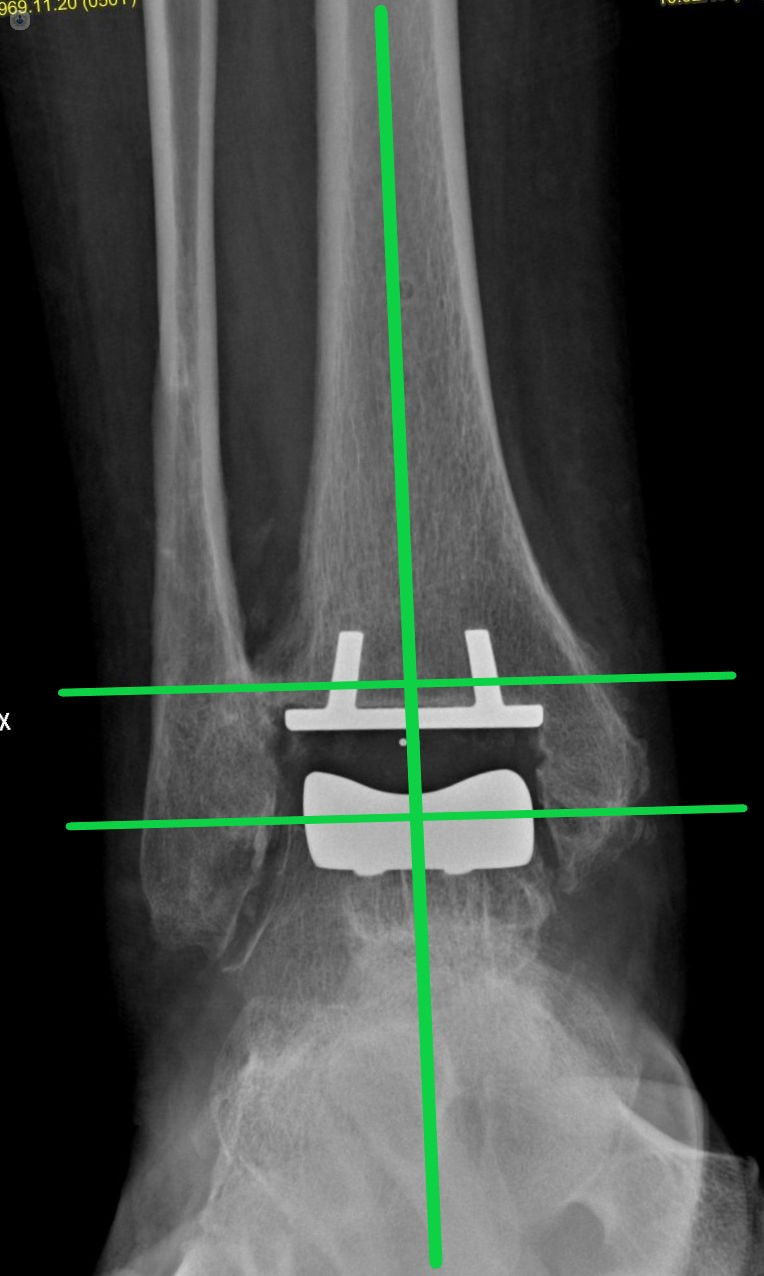 Rx postoperatoria allineamento protesi caviglia