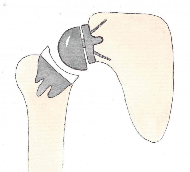 Spalla inversa protesi senza stelo