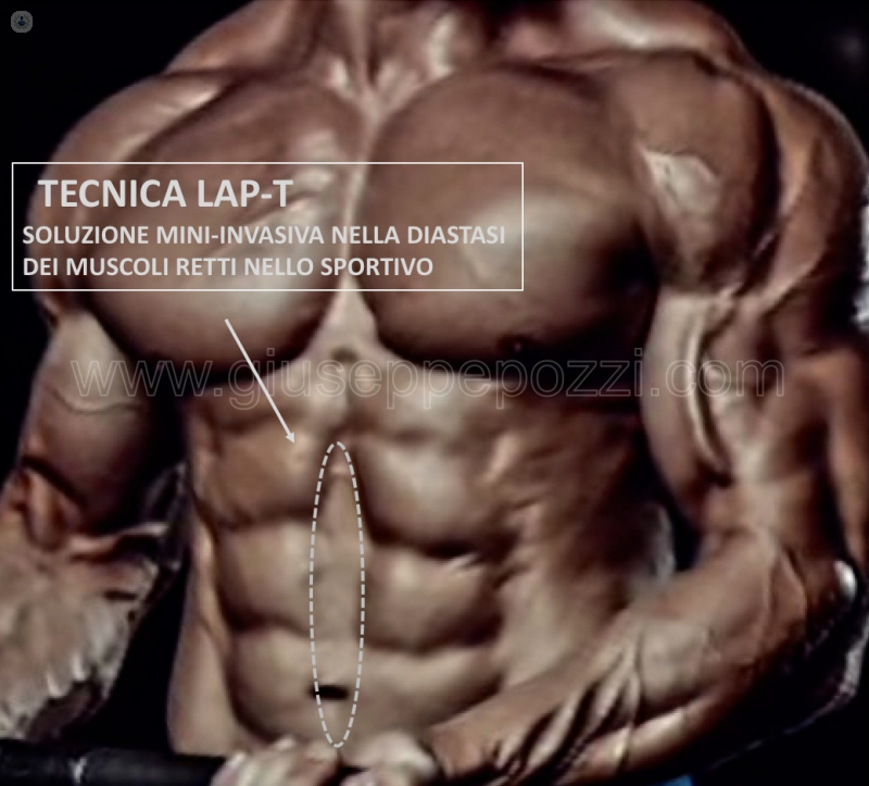 Tecnica LAP-T, suluzione mininvasiva nella diastasi dei muscoli retti nello sportivo