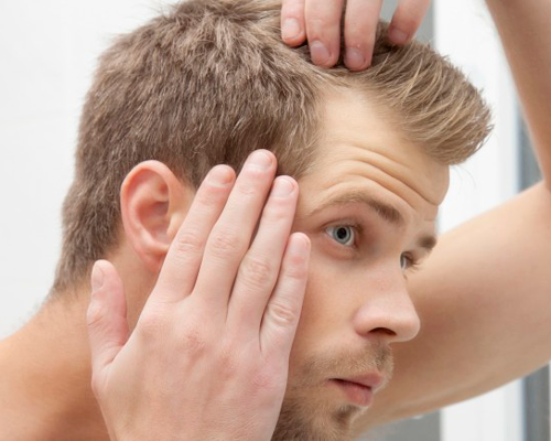 ragazzo che si guarda allo specchio perché sta perdendo i capelli