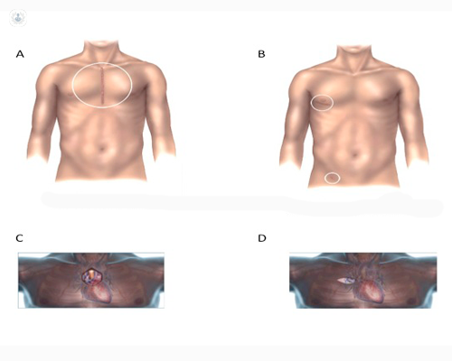 A: sternotomia mediana - B: minitoracotomia laterale - C: ministernotomia - D: minitoracotomia anteriore