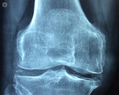 radiografia di un osso