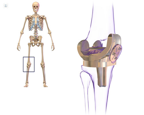 protesi del ginocchio