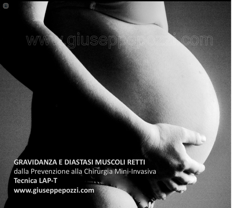 gravidanza e diastasi muscoli retti