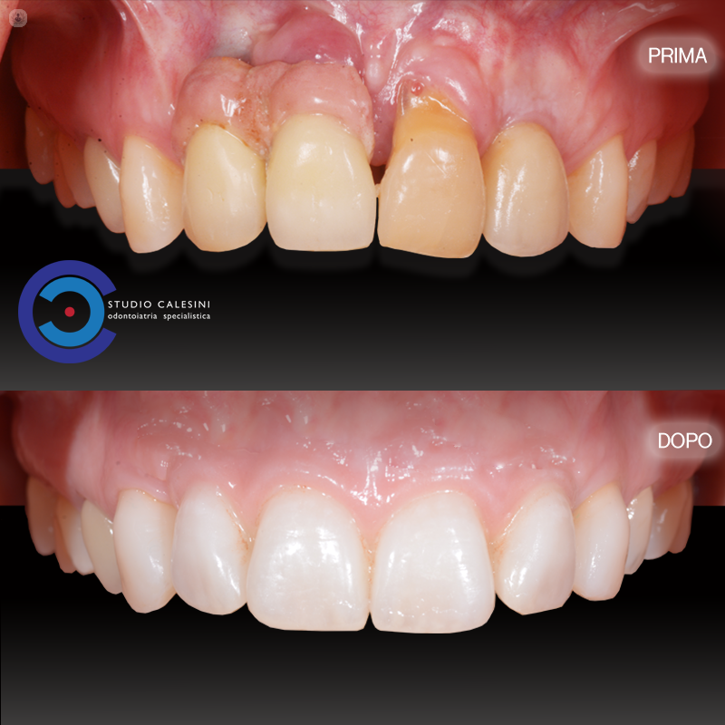 impianti dentali