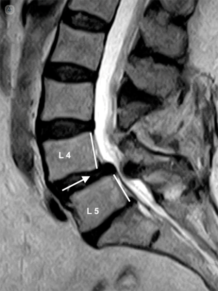 RM di una colonna vertebrale con spondilolistesi