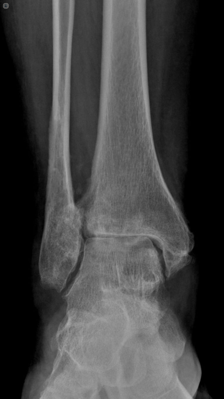 artrosi caviglia