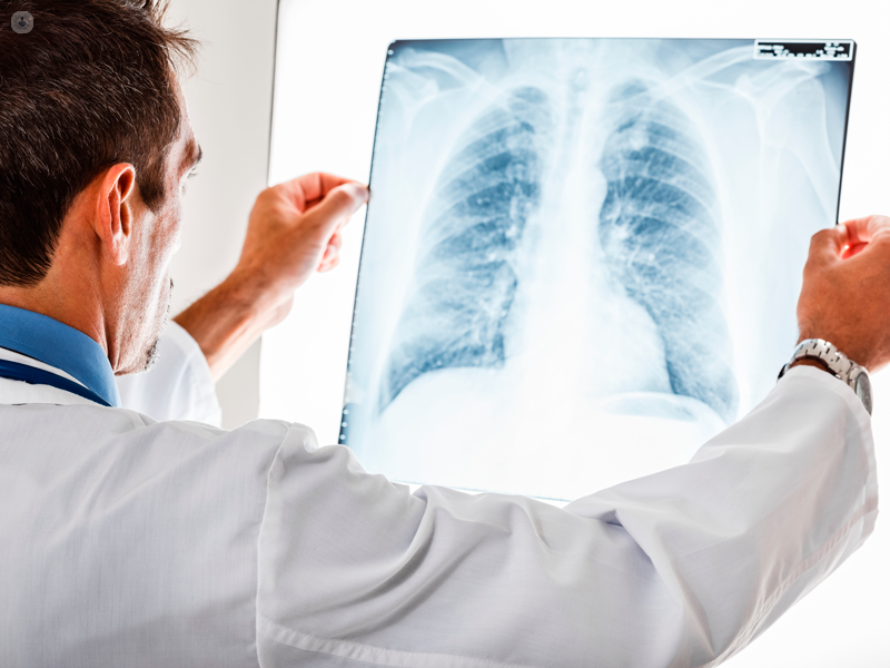 radiografia polmoni
