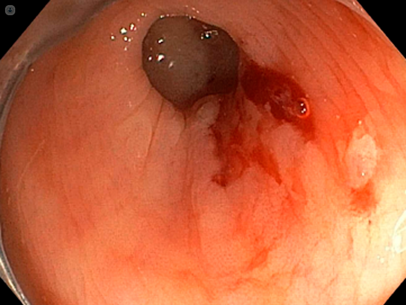 diverticoli