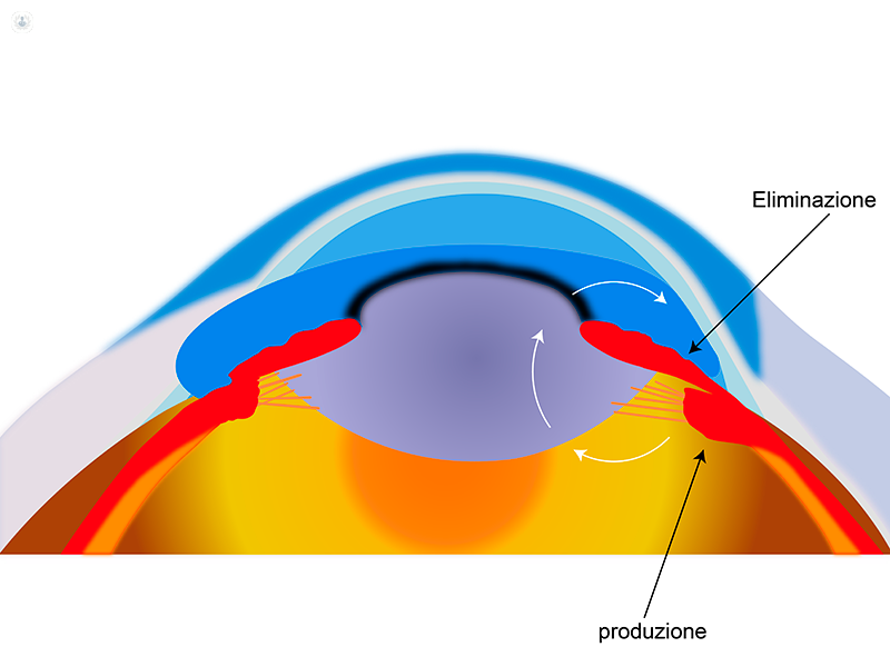 immagine esplicativa di eliminazione del glaucoma