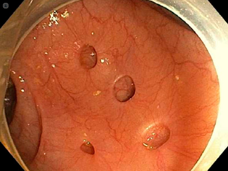 diverticoli